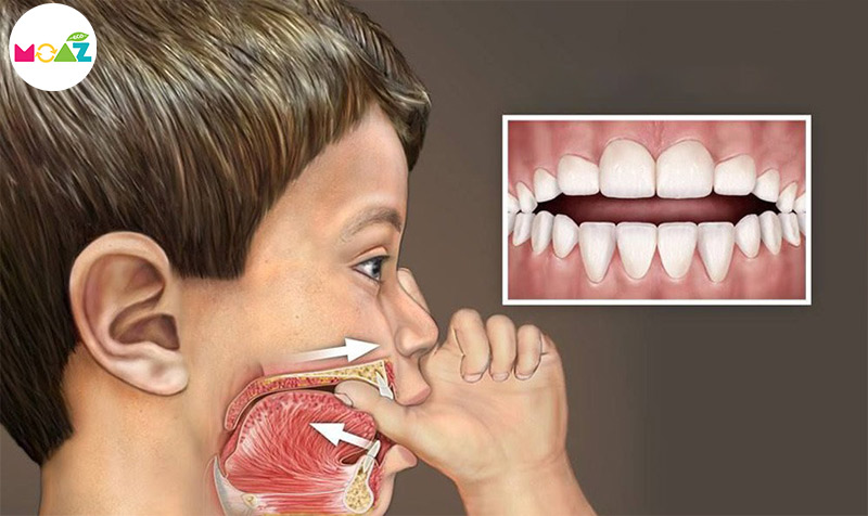 nguyên nhân khiến răng bé mọc lệch khi thay răng
