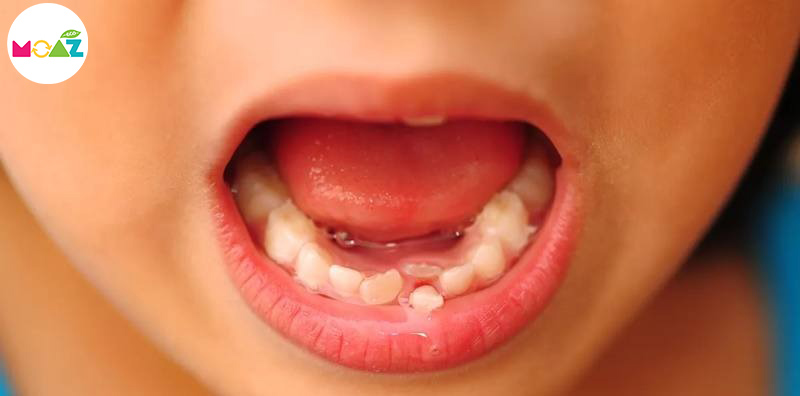 Răng bé mọc lệch vào trong có tự hết không?