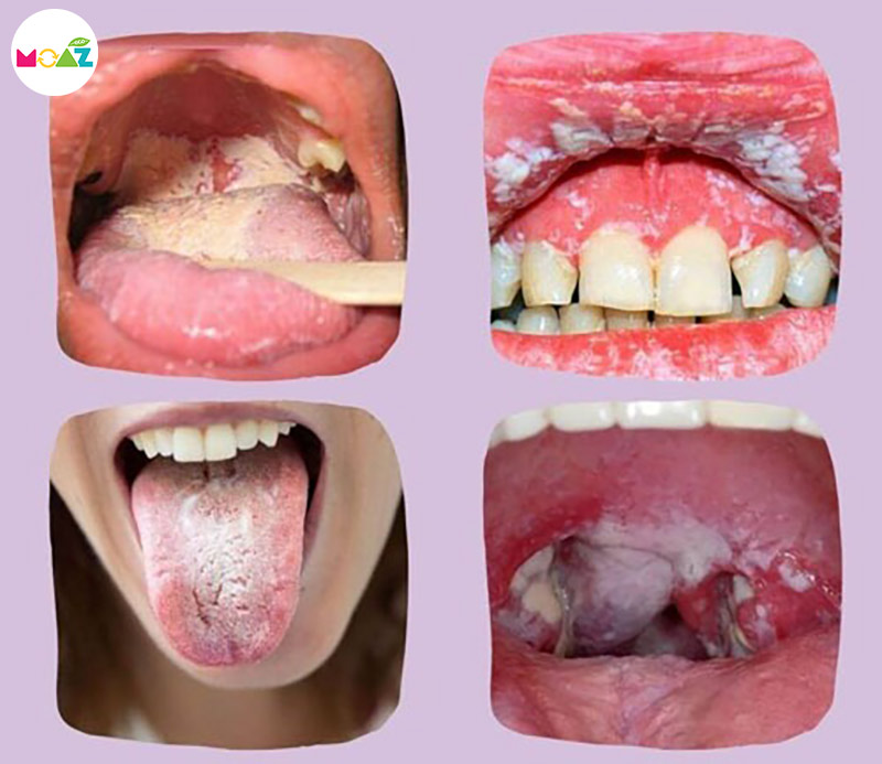 Hình ảnh nấm miệng ở trẻ em