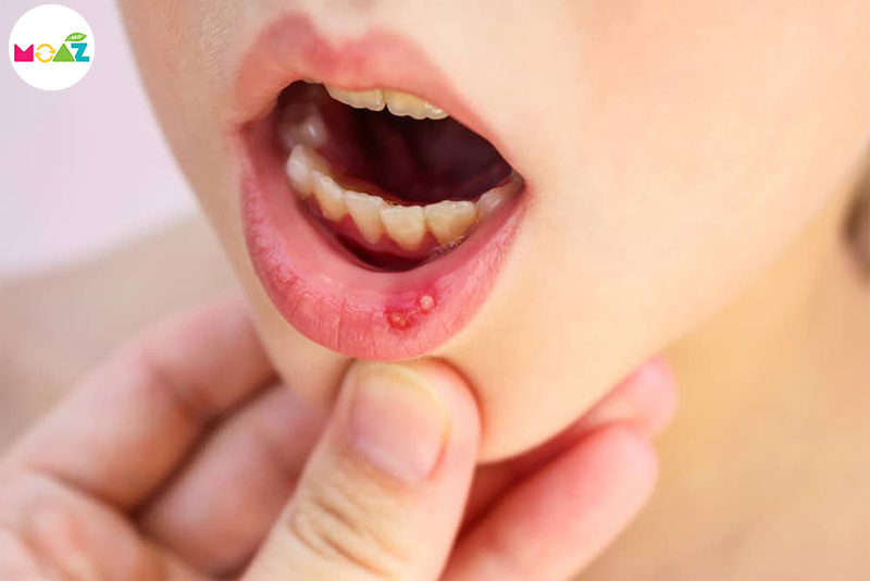 nấm miệng ở trẻ trên 1 tuổi
